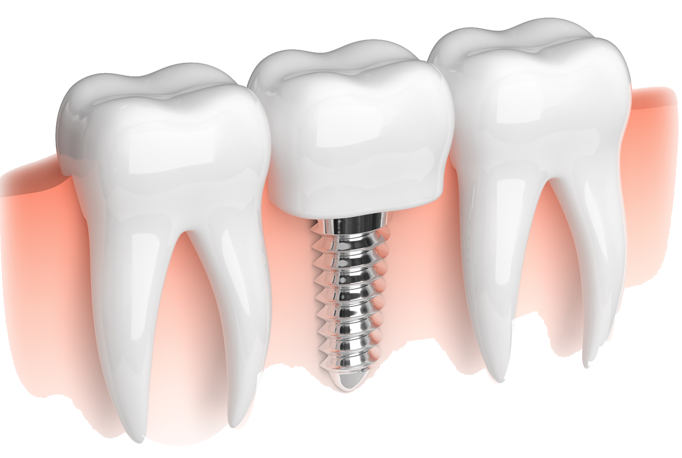 Dental Implant Antalya