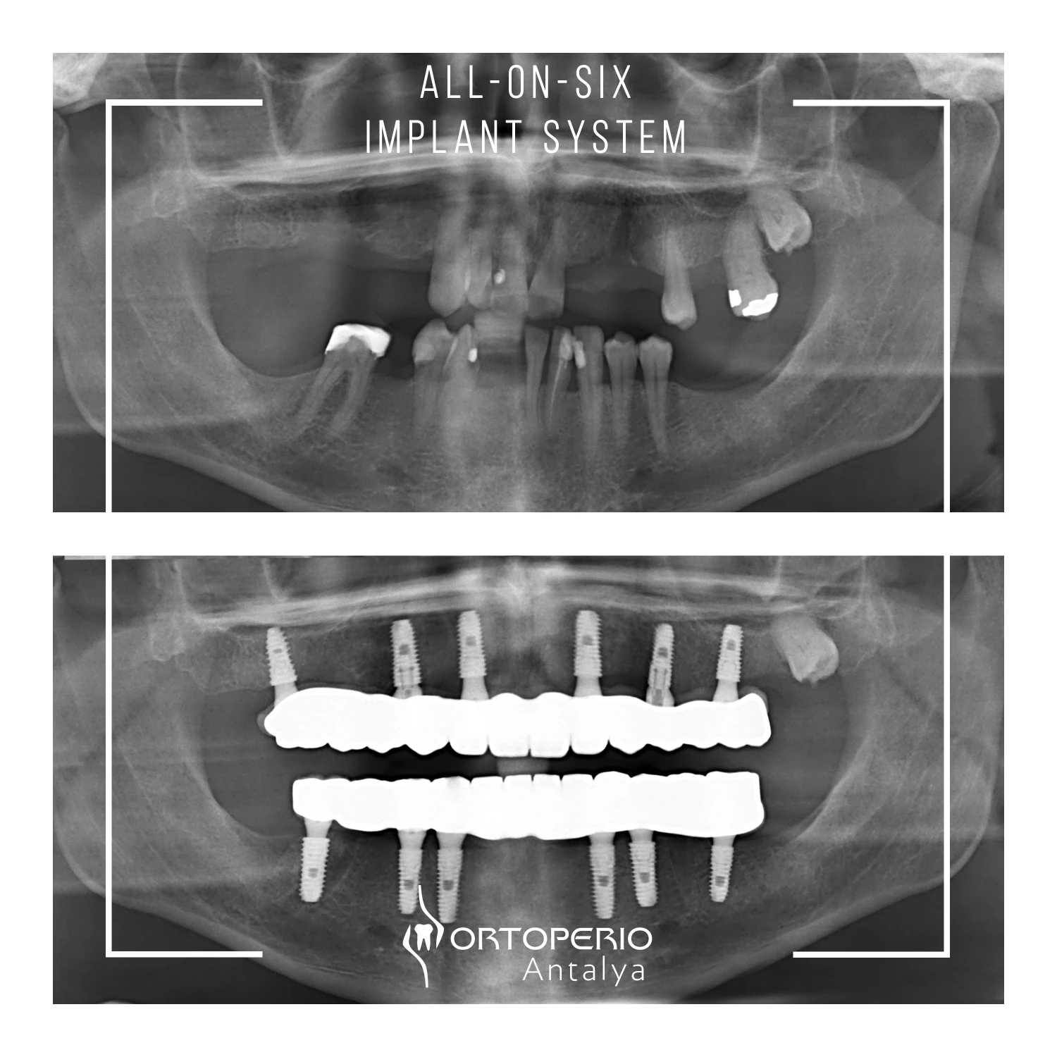 All on six dental implant x-ray before after result