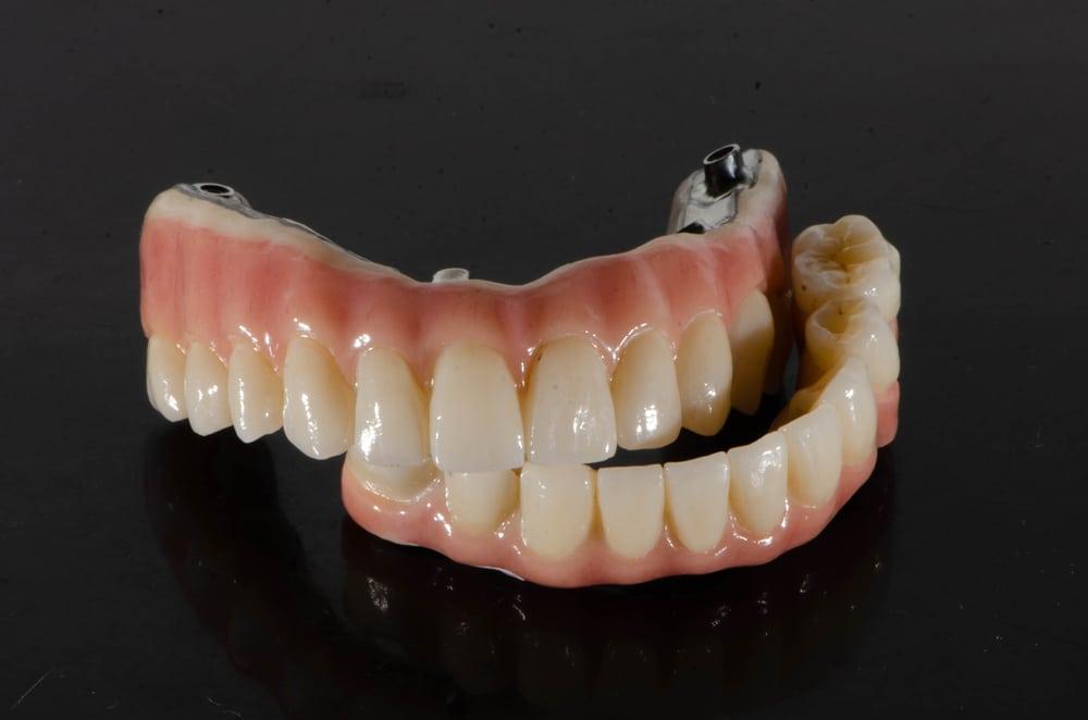 Integrating All-on-Four Implants into Your Lifestyle for Lasting Well-Being
