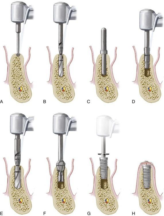 Tips for Preparing and Recovering During Your Dental Implant Experience
