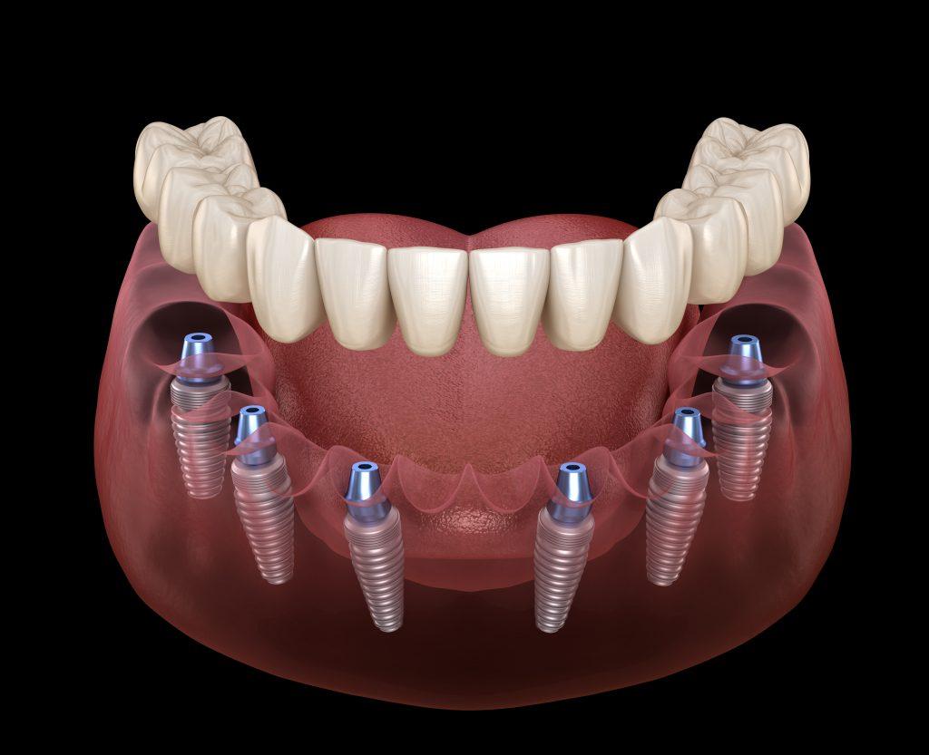 Affordable All on Six Implant Options Designed for UK Patients