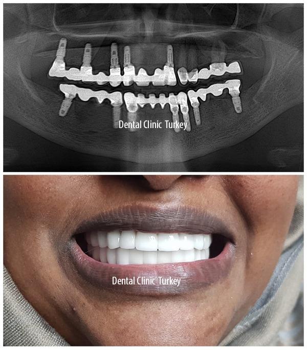 Why “Full Mouth Restoration Antalya” Leads UK Patients to All-on-Four and All-on-Six Treatments