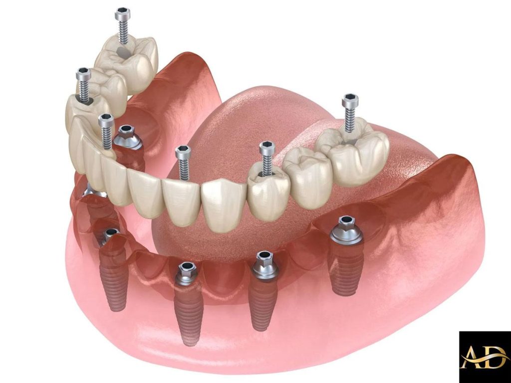 Safe and Sound: Ensuring Quality and Safety for Your All-on-Six Implants in Antalya (UK Patient Guide)