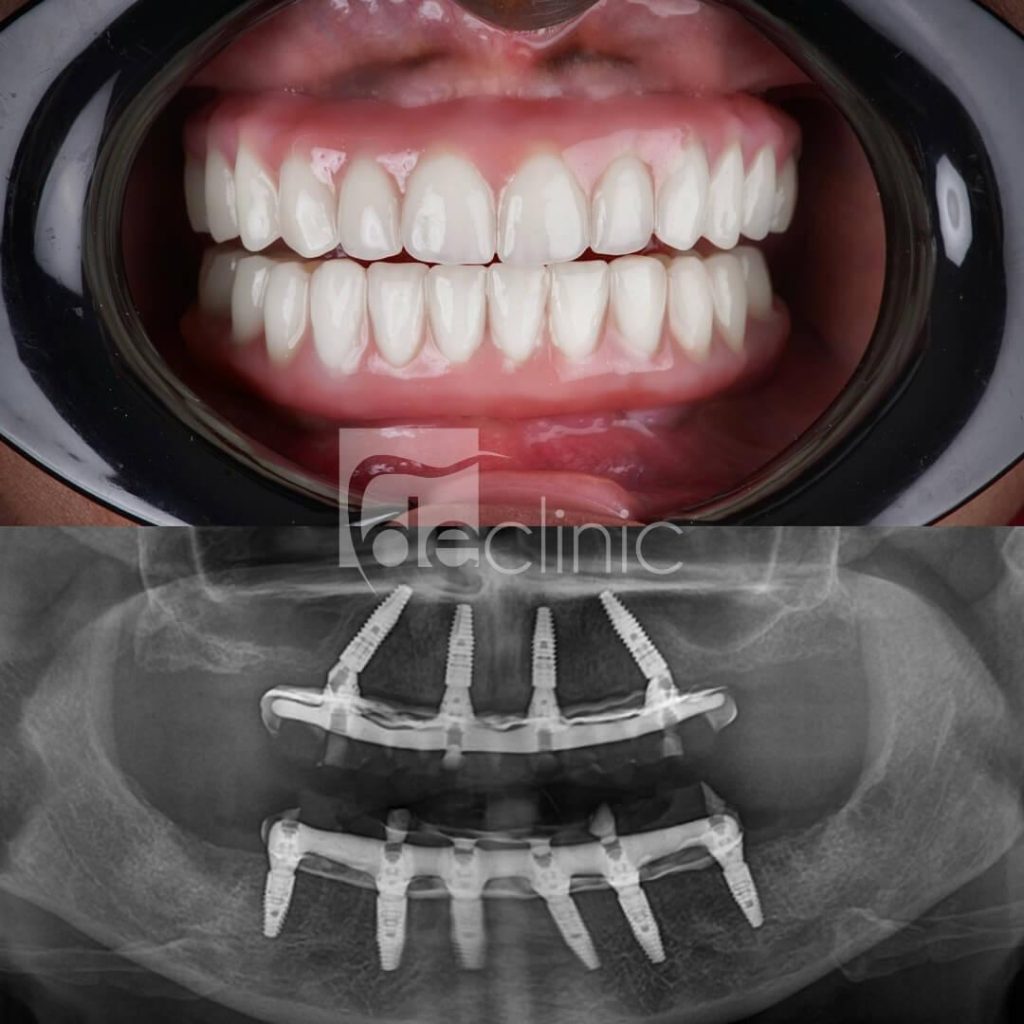 Bone Loss and Dental Implants: Can All-on-Four in Antalya Still Be an Option for You?