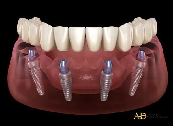 Antalya: The UK’s Top Destination for Affordable & High-Quality All-on-Four Implants