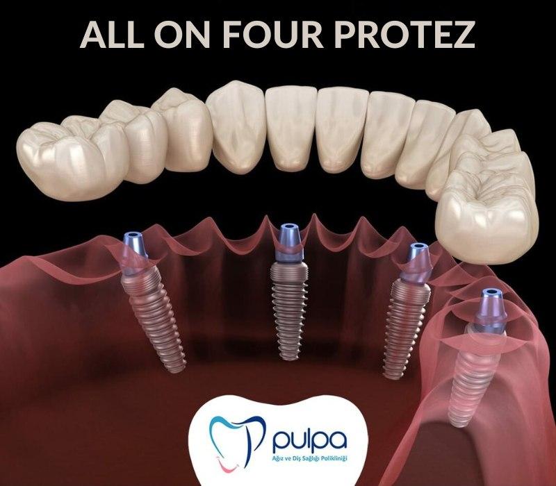 Boosting Your Quality of Life: The Long-Term Benefits of All-on-Four Implants from Antalya