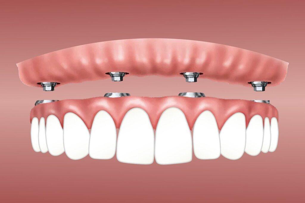 Planning Your Dental Trip: Tips for UK Patients Travelling to Antalya for All-on-Four Implants
