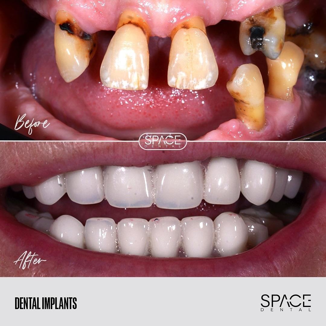 Managing Costs and Insurance When Traveling for Dental Implants