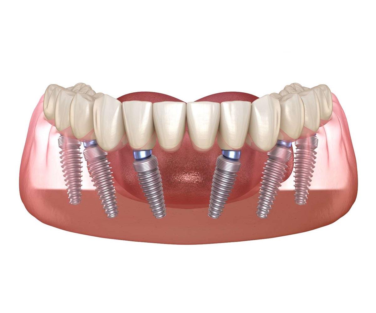 How to Choose the Right Dental Provider for Your Implant Journey