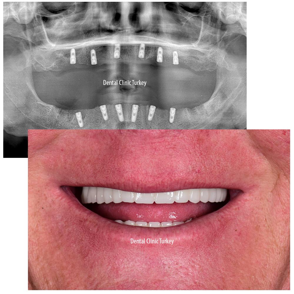 Post-implant Care Strategies to Maintain Longevity and Oral Health