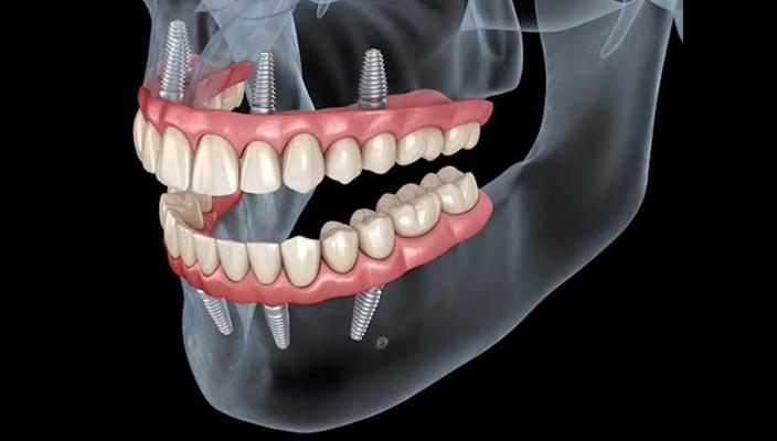 Essential Tips for UK Patients Planning Affordable All on Six Procedures Abroad