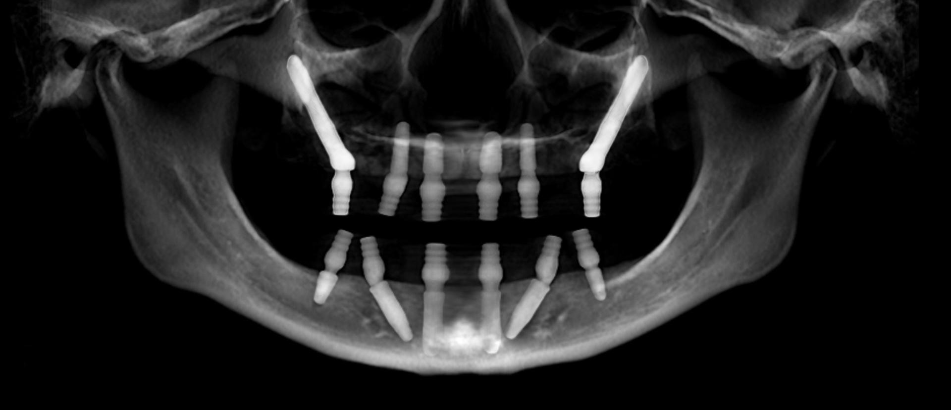 Understanding Bone Loss and Its Impact on Dental Implant Success