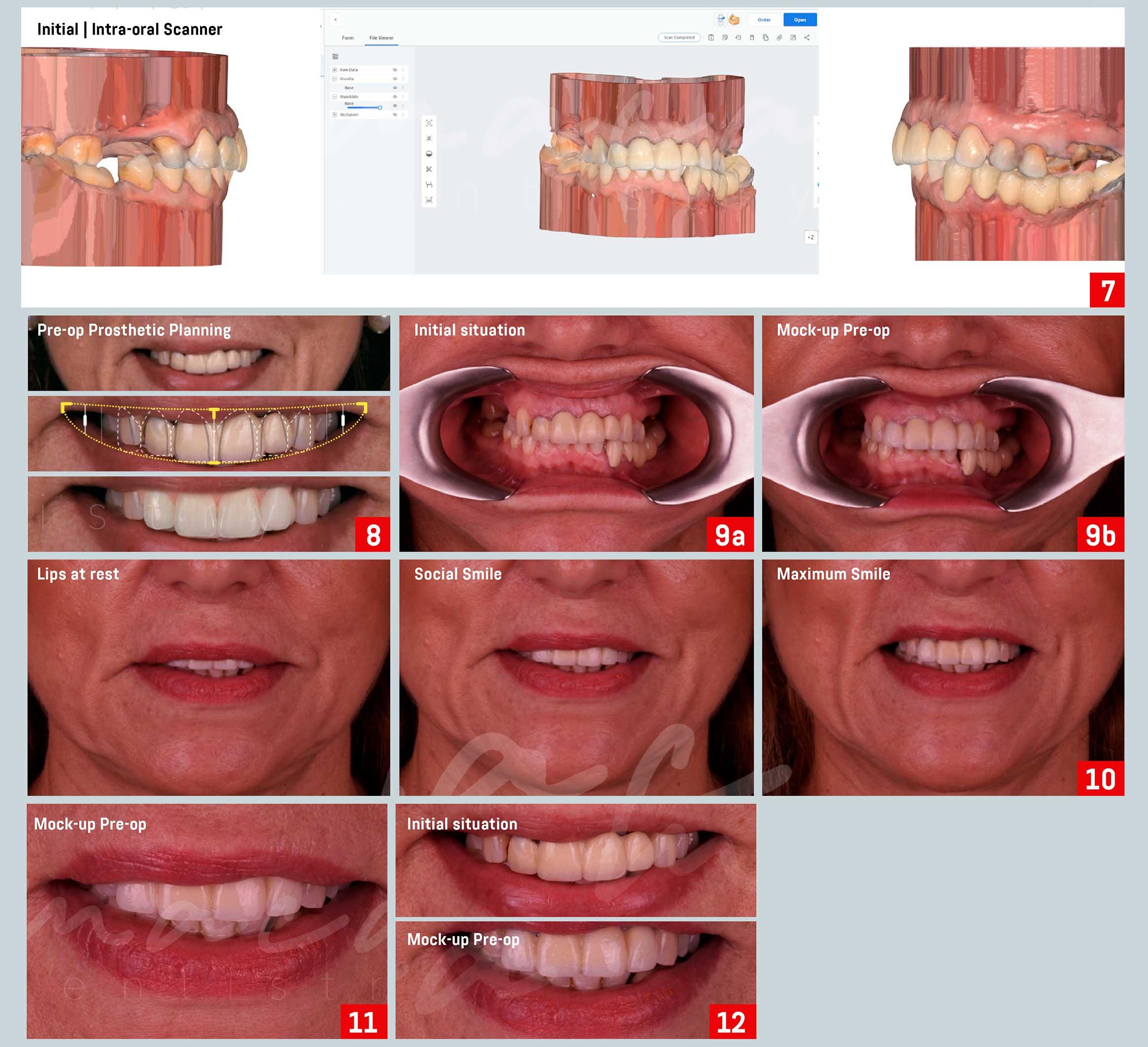 Tailoring Full Mouth Rehabilitation Plans to Maximize Long-Term Oral Health Outcomes