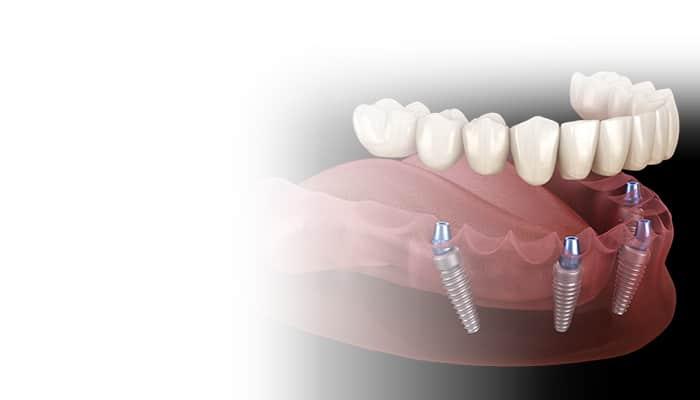 Understanding the Benefits of All-on-Four and All-on-Six Techniques for UK Patients