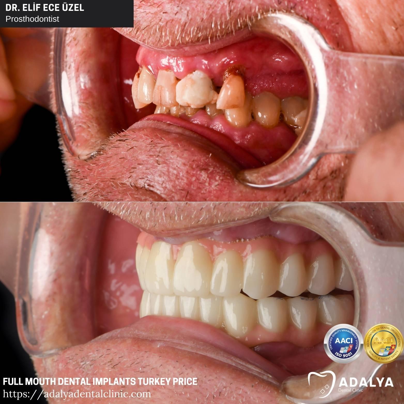 Expert Recommendations for Choosing the Right Full Mouth Implant Procedure in Antalya