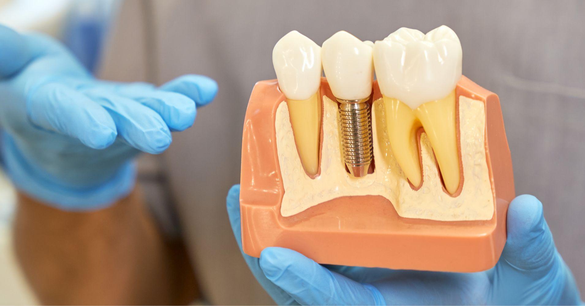 Innovative Techniques to Enhance Bone Quality for Implant Stability
