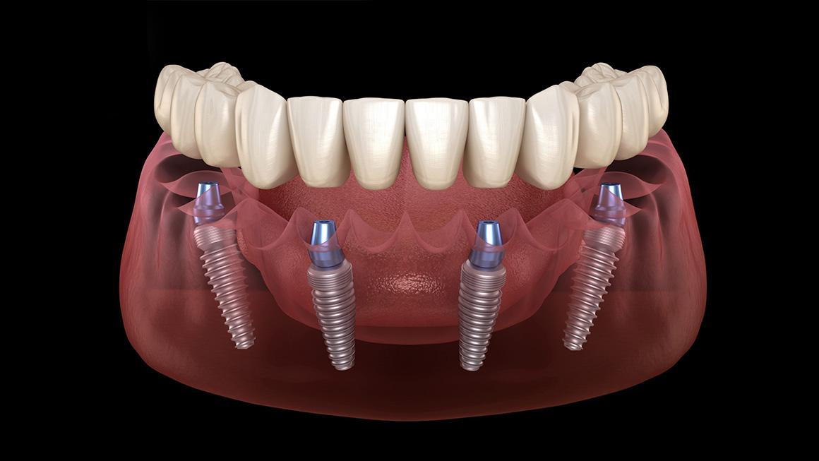 Comparing All-on-4 and All-on-6 Implant Solutions for Optimal Patient Outcomes