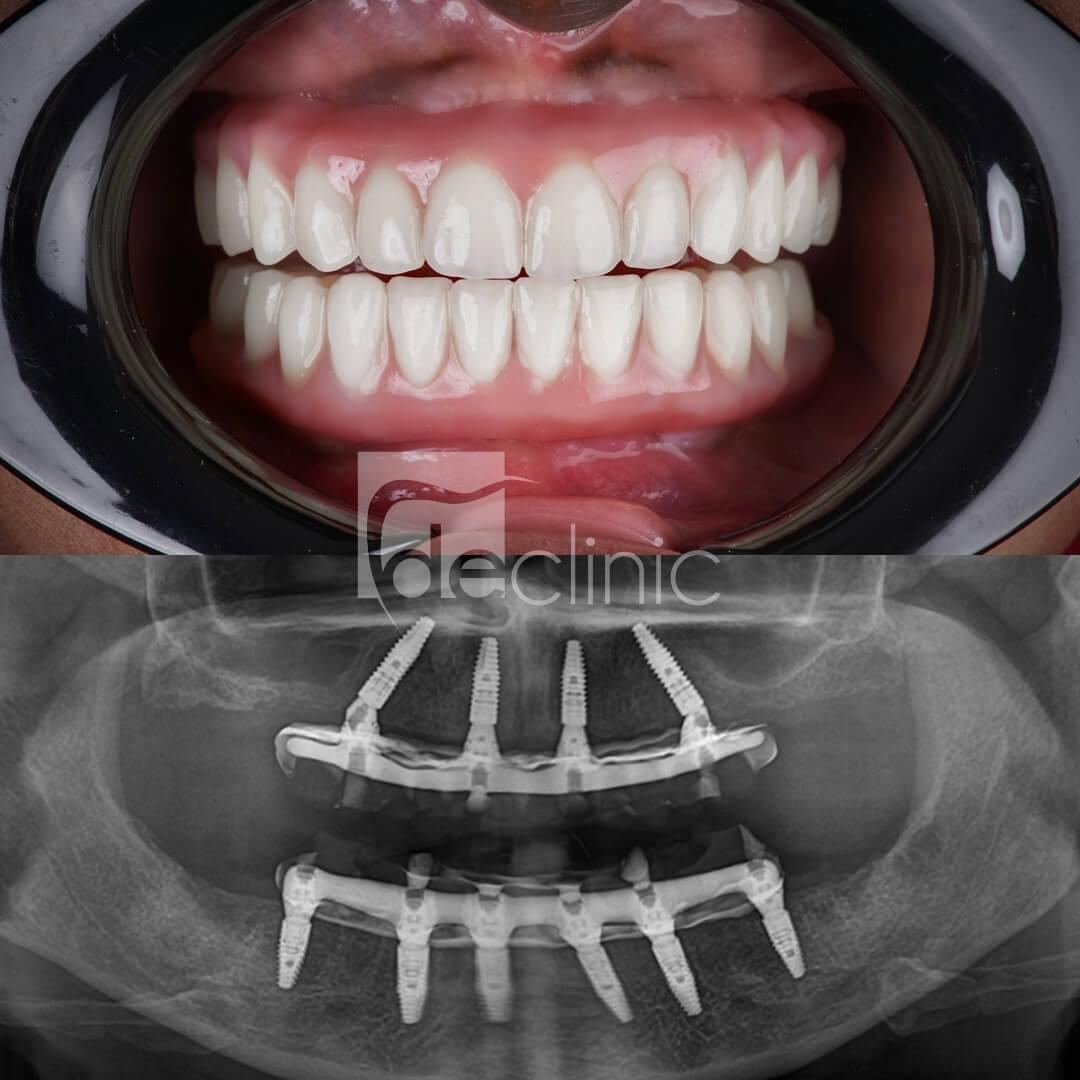 Understanding the All-on-Four Procedure and Its Benefits