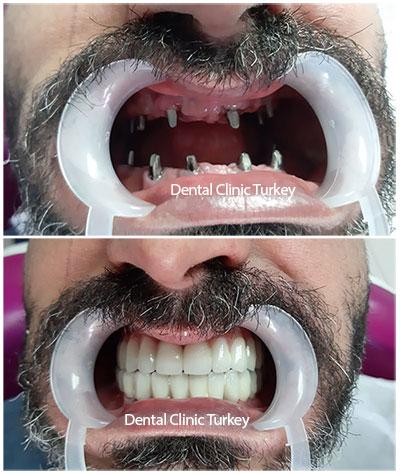 Full Mouth Restoration Antalya as a Gateway to Advanced Dental Solutions