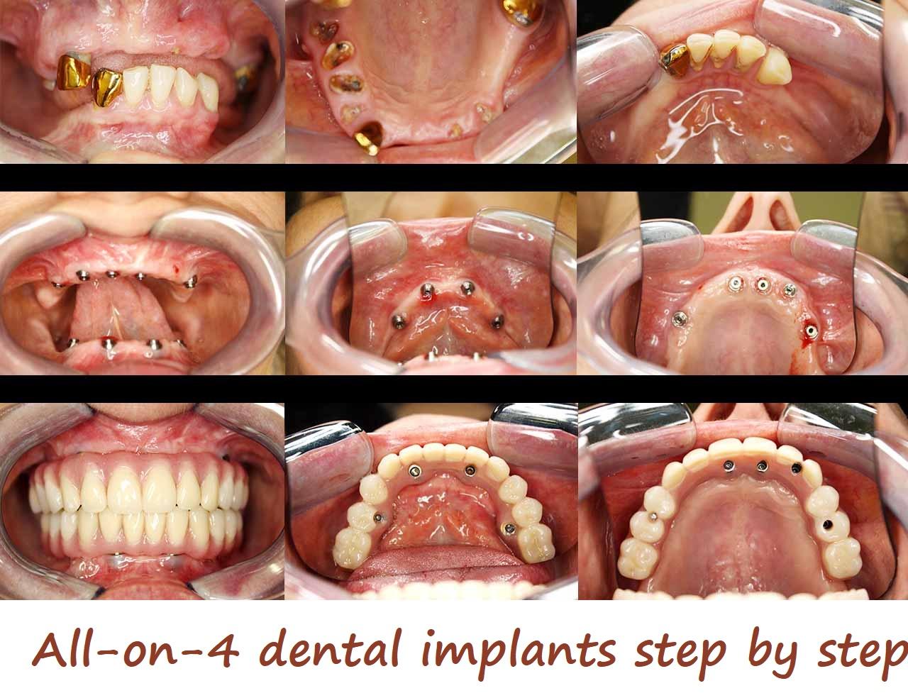 Understanding the All-on-Four Procedure Through Clear Communication