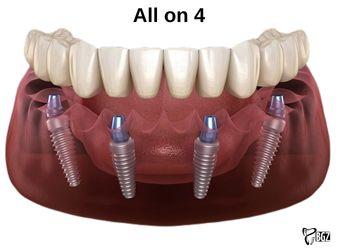 All-on-Four Treatment in Antalya Exploring Cutting-Edge Dental Solutions