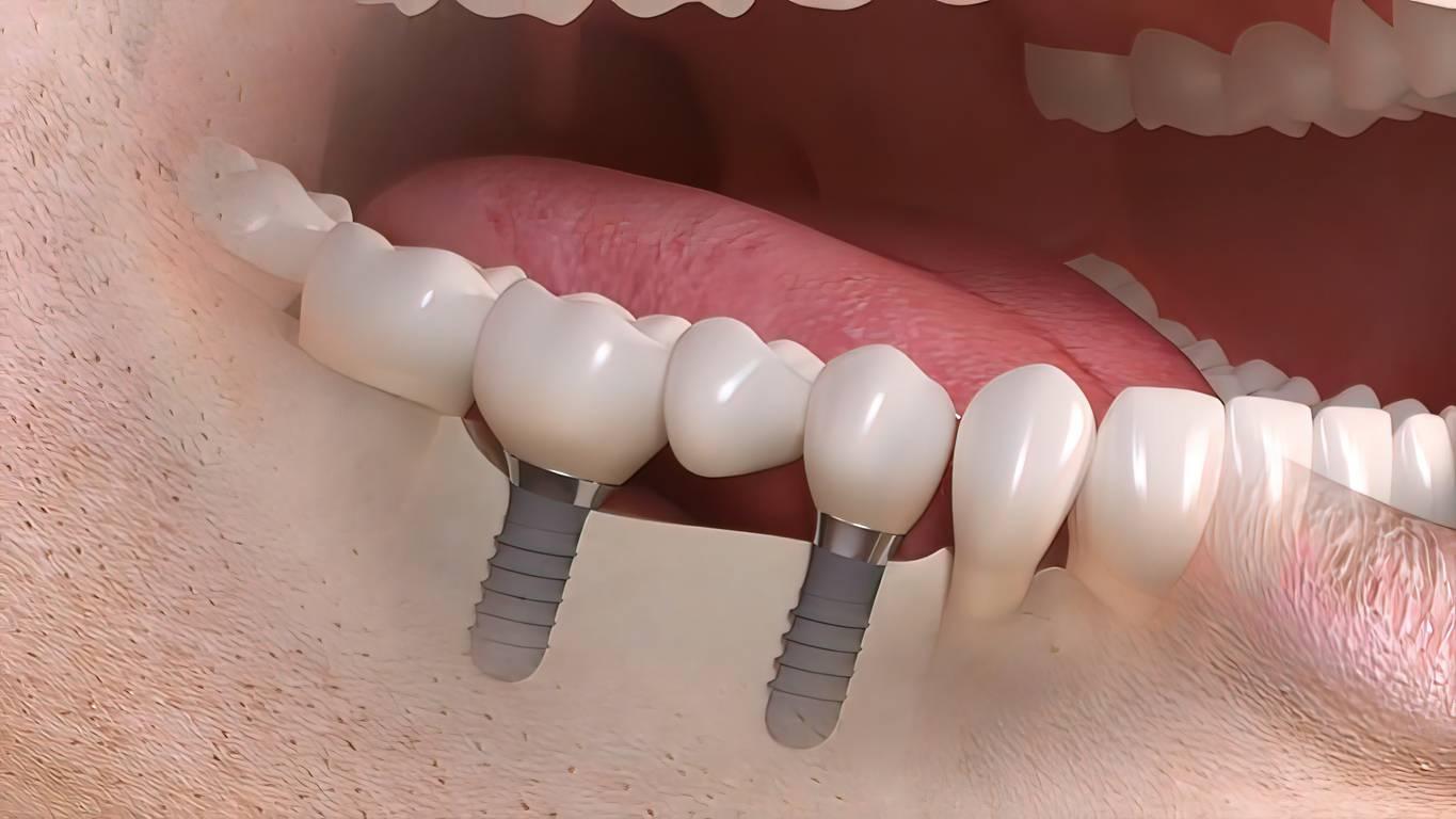 Understanding the Importance of a Second Opinion in Dental Implant Procedures