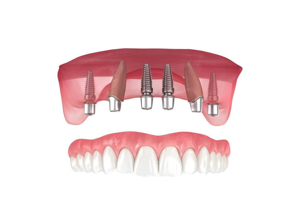 All-on-Six Antalya: Is This Advanced Implant System Right for You? (UK Focus)