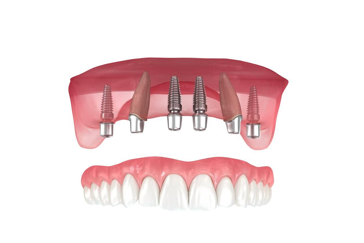 Choosing the Right Solution for Your Smile Comprehensive Consultation and Personalized Plans