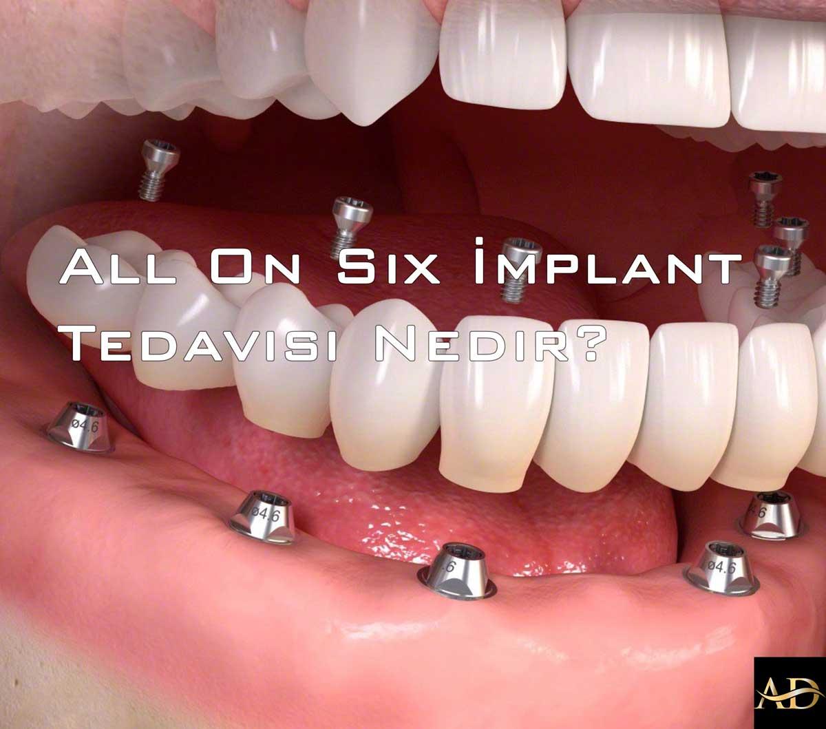 Understanding the All on Six Procedure and Its Benefits in Antalya
