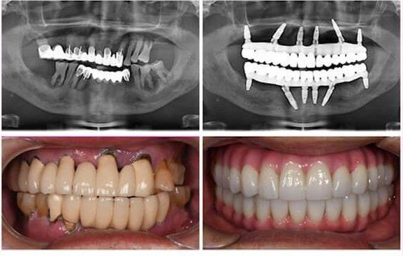 Choosing a Dental Clinic in Antalya: A UK Patient’s Checklist for All-on-Six Implants