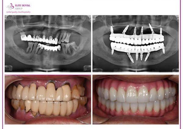 Practical Tips for Maintaining All-on-Six Implants for Long-Term Success