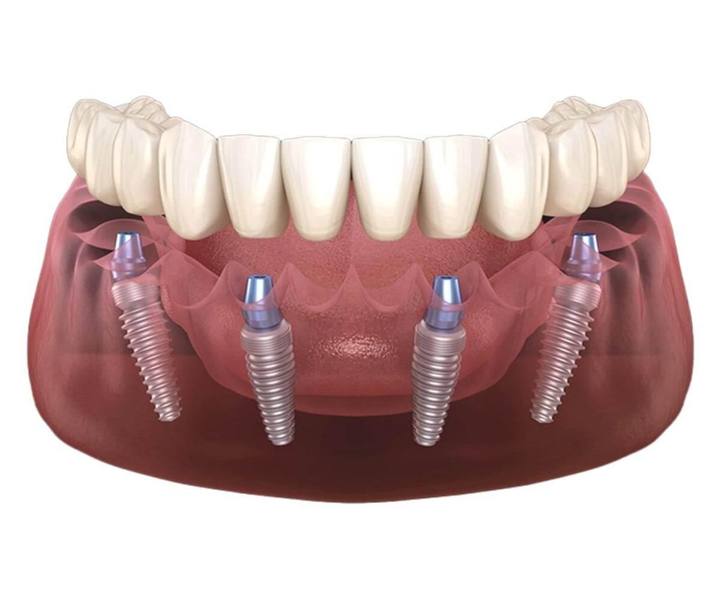 All-on-4 vs. All-on-6 Implants in Antalya: Which is Best for Your Needs, UK Patients?