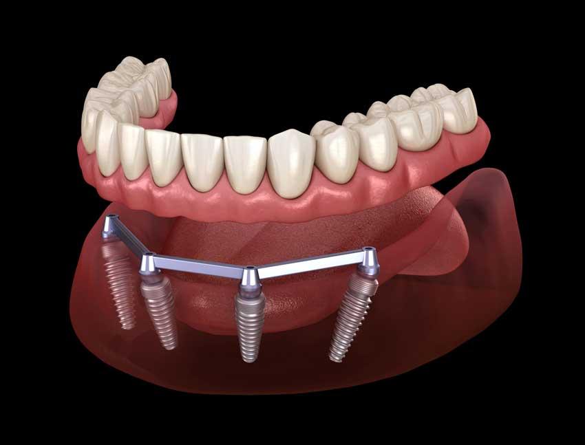 “All on Four Implant Antalya”: What Makes This a Top Search for UK Smile Seekers?
