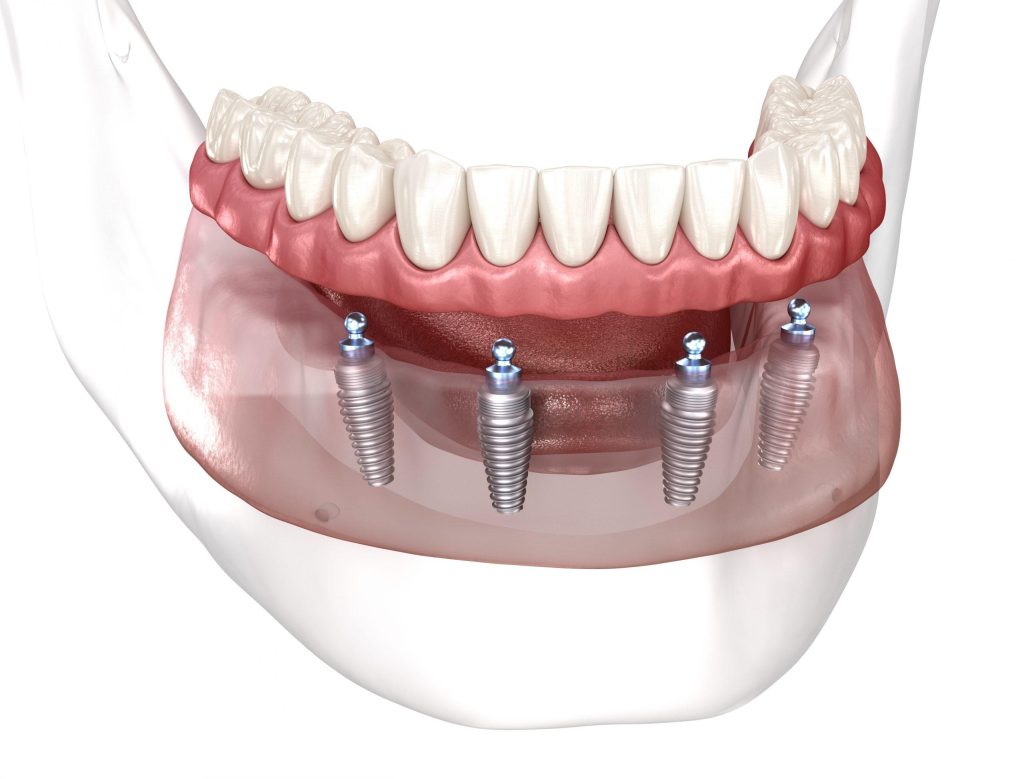 Our Commitment to UK Patients: Guarantees and Support for All-on-Four Implants at OrtoperioAntalya