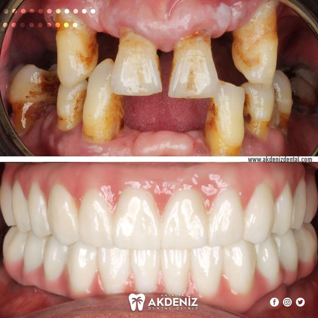 Questions to Ask Your Antalya Dentist Before Getting All-on-Six Implants (UK Patient Edition)