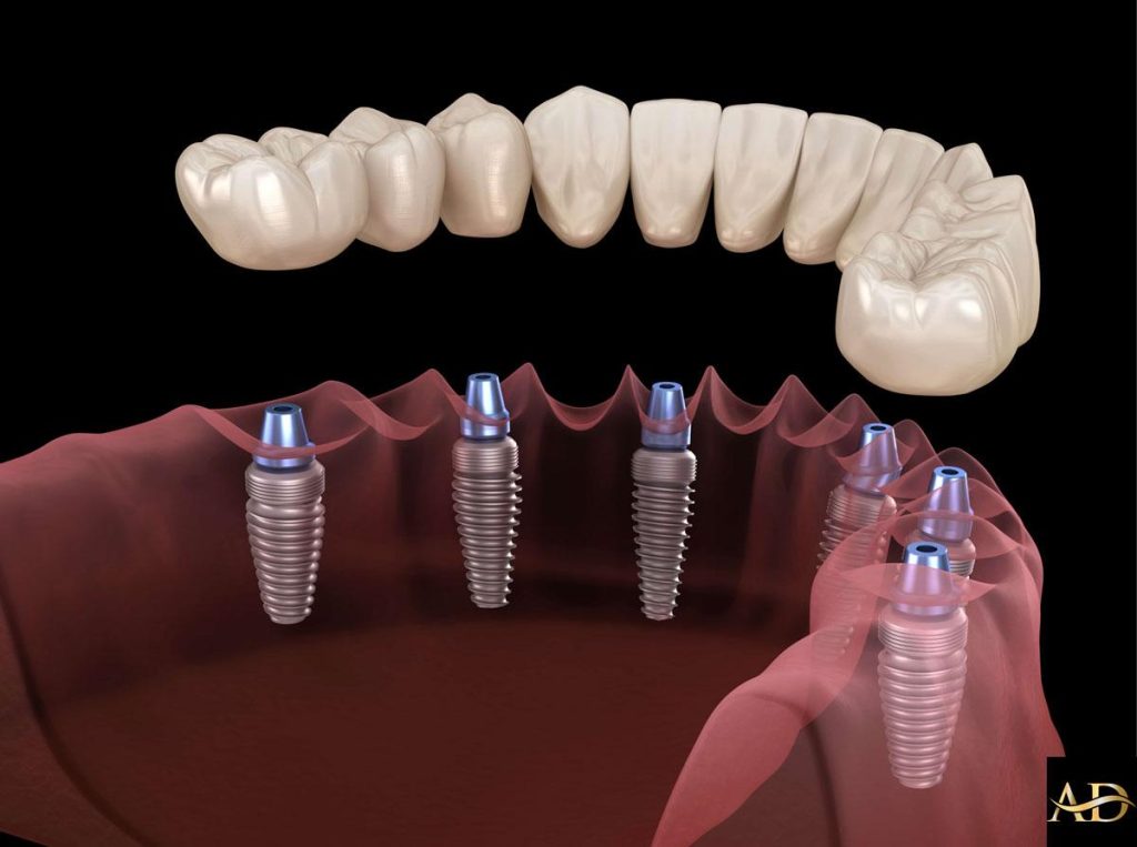 Smart Investment: How All-on-Six Implants in Antalya Offer Long-Term Value for UK Patients