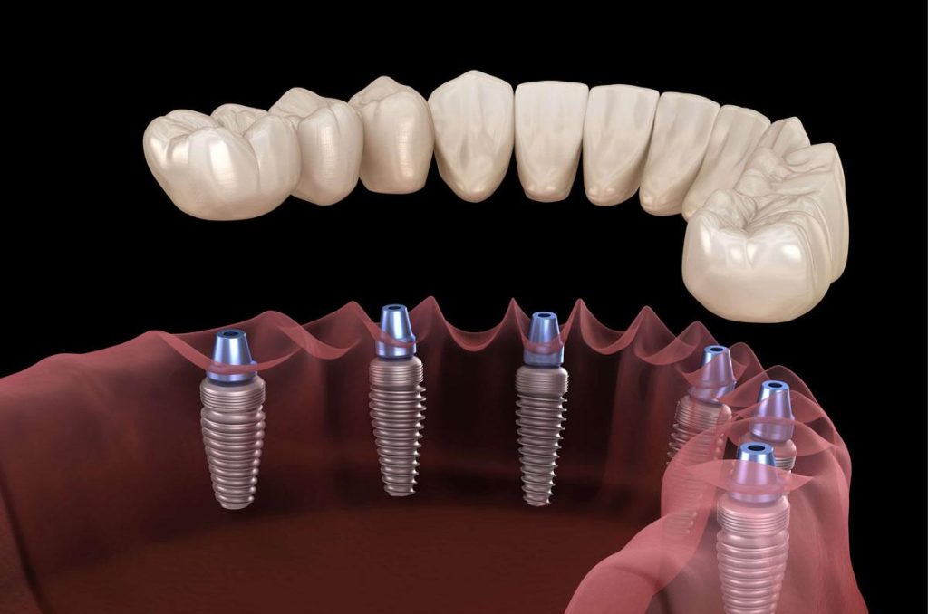Smart Investment: How All-on-Six Implants in Antalya Offer Long-Term Value for UK Patients