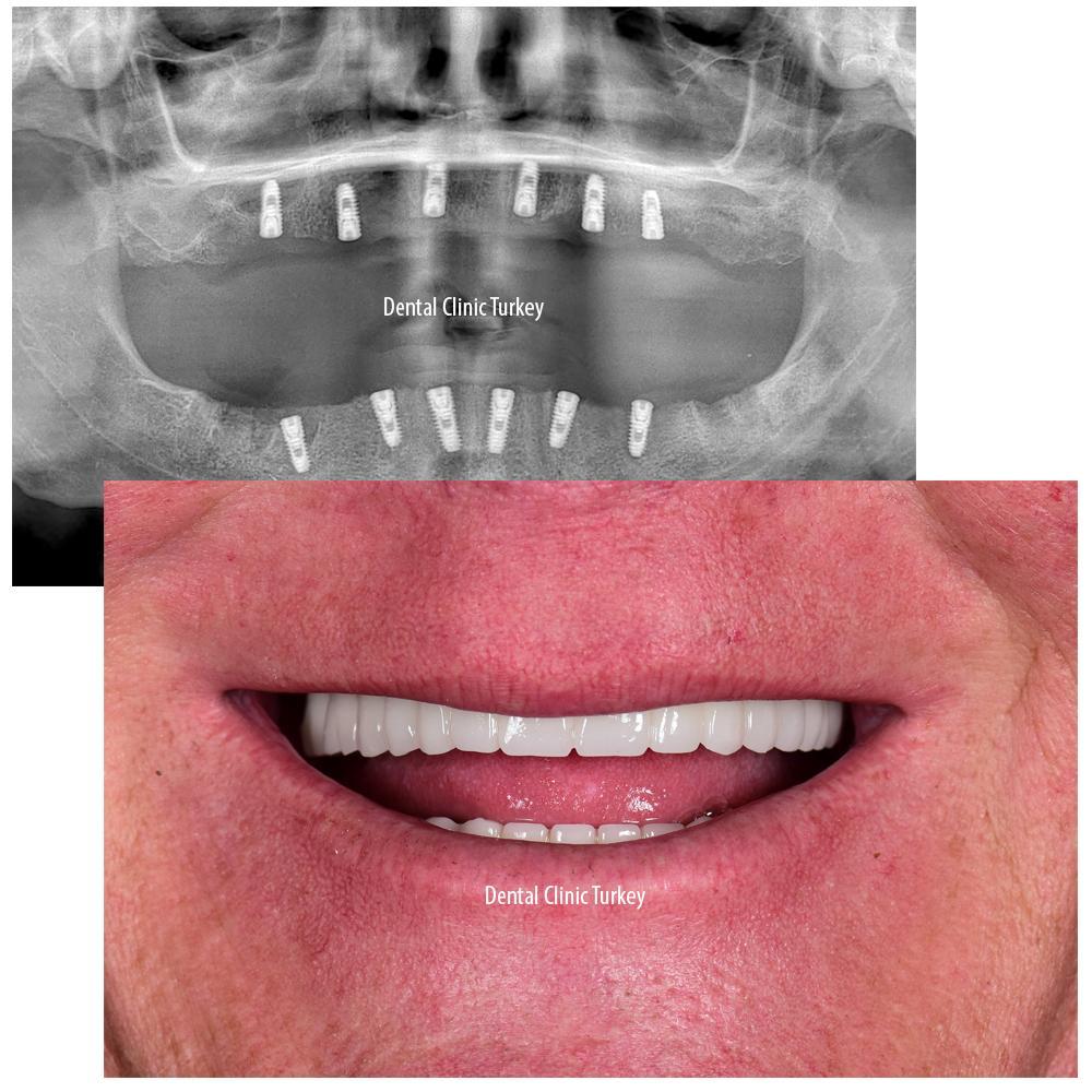 The OrtoperioAntalya Advantage: Quality All-on-Six Implants for Our UK Patients
