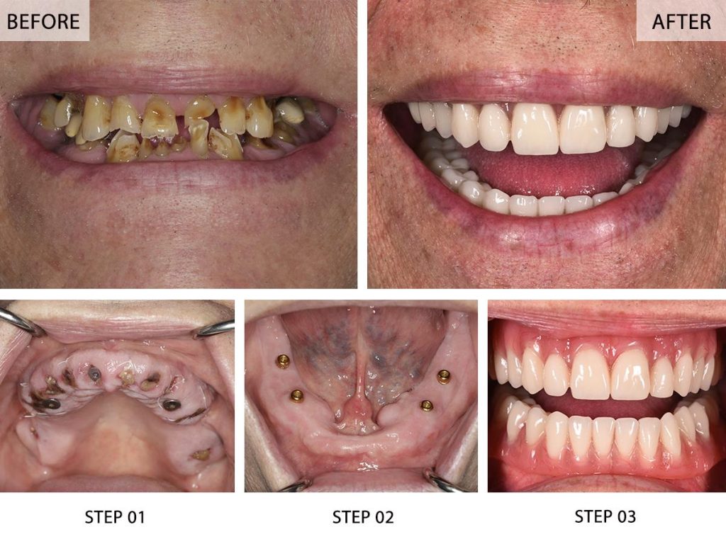The Transformation: Before & After All-on-Four Dental Implants in Antalya (UK Perspectives)