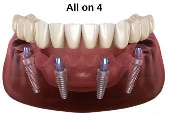 All-on-Four Dental Implants Antalya