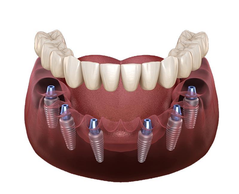 Compare Your Options: All-on-Six Implants in Antalya vs. Alternatives in the UK