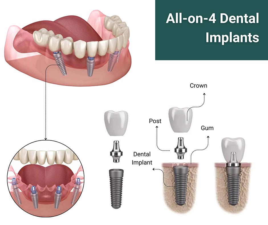 The Science Behind a Secure Smile: How All-on-4 Implants Work (Antalya Clinic Insight)