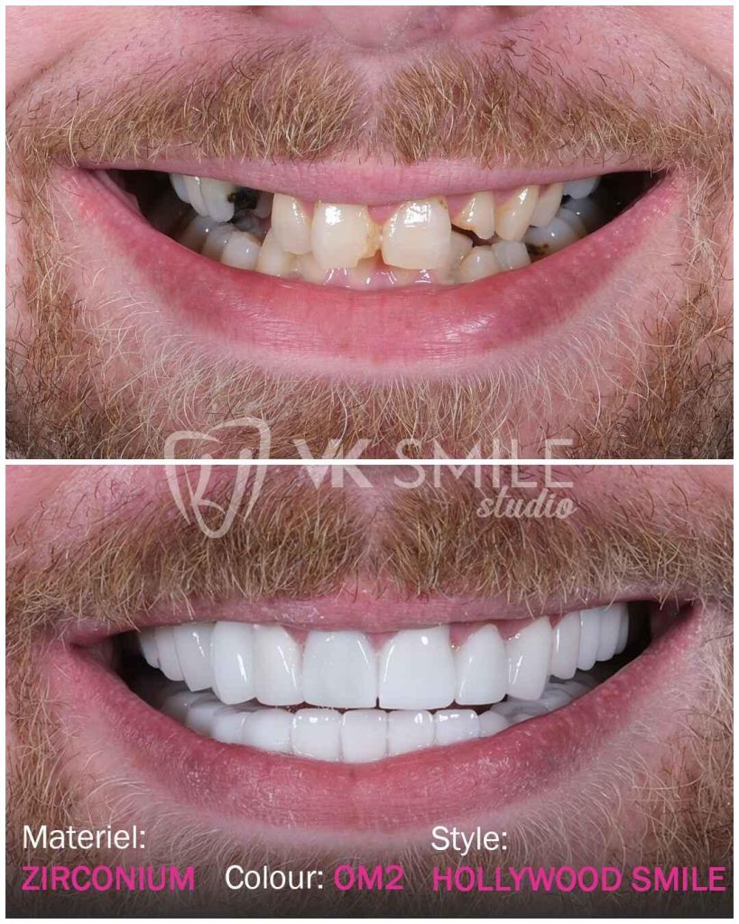 The Truth About “Dental Tourism Risks”: How Reputable Antalya Clinics Ensure UK Patient Safety for All-on-4