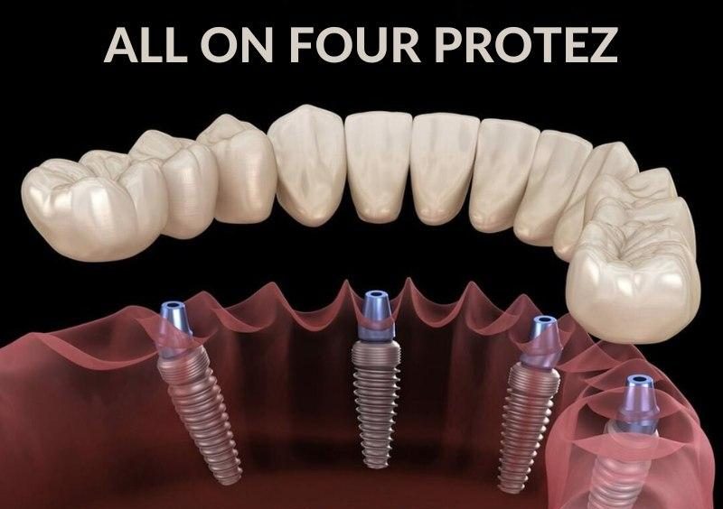 All-on-4 Dental Implants in Antalya: Your Complete Guide for UK Patients