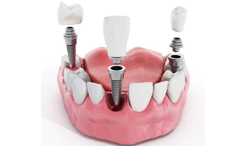 Expert Recommendations for Maintaining Long-Term Implant Success