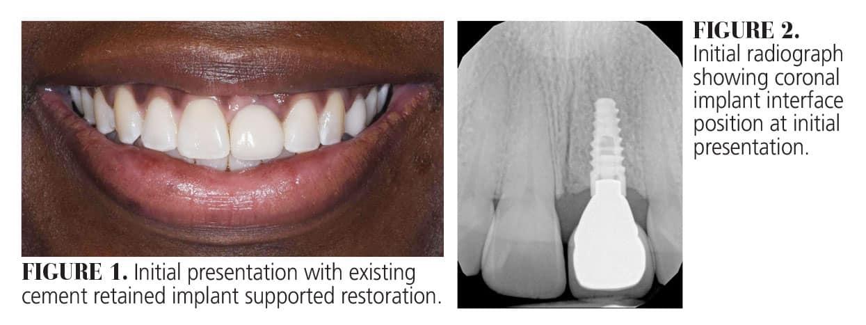 Assessing Cosmetic Outcomes and Comfort in Dental Implant Choices
