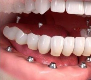 Compare Your Options: All-on-Six Implants in Antalya vs. Alternatives in the UK