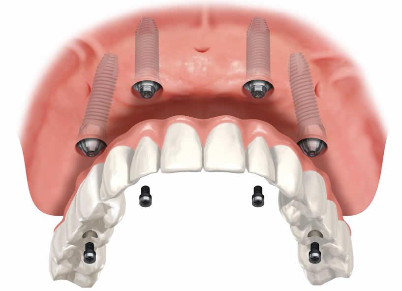 Maximizing Results with Aftercare Essential Recommendations for Long-lasting Oral Health and Confidence