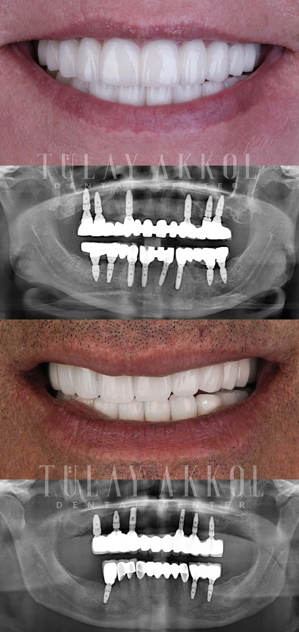The Transformative Benefits of All-on-Six Implants on Oral Health