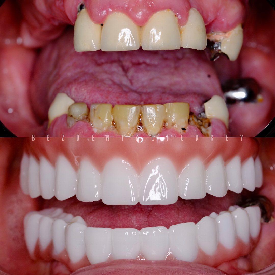 Patient Experiences That Showcase the Transformative Power of Quality All-on-6 Treatment